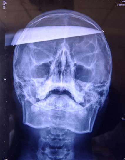 Accused Counter-Strike Cheater Gets Stabbed in Head and Survives!